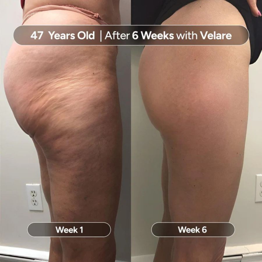 M3 Anti - Cellulite Massage Oil - SkinViral